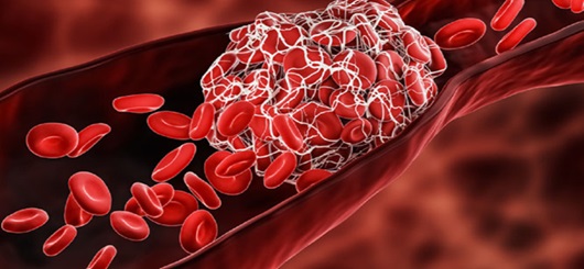 Eine frühere Behandlung mit Blutverdünnern könnte das Risiko verringern, einen erneuten Schlaganfall zu erleiden